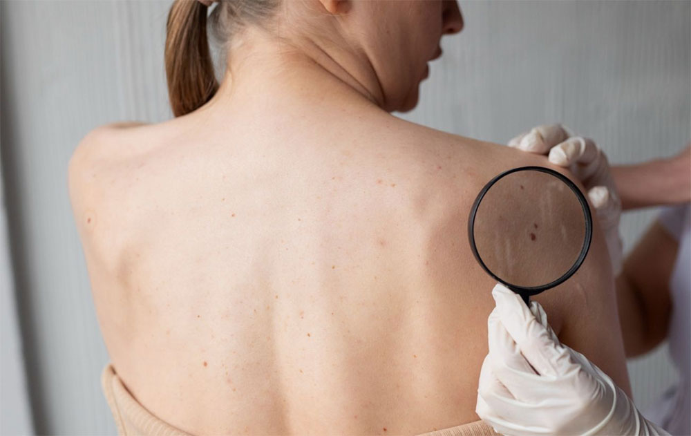 Как проверить наличие признаков рака кожи?