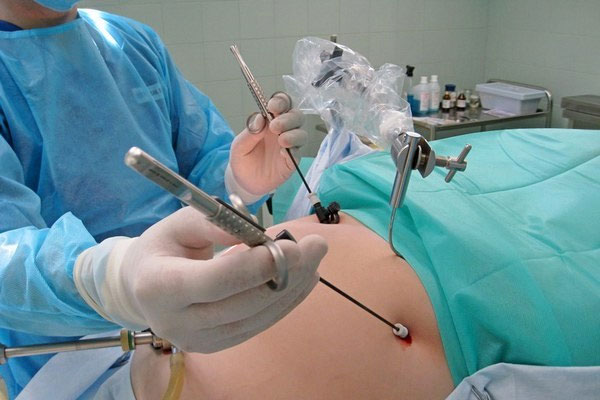 Лапароскопия матки: для чего проводится и какова эффективность